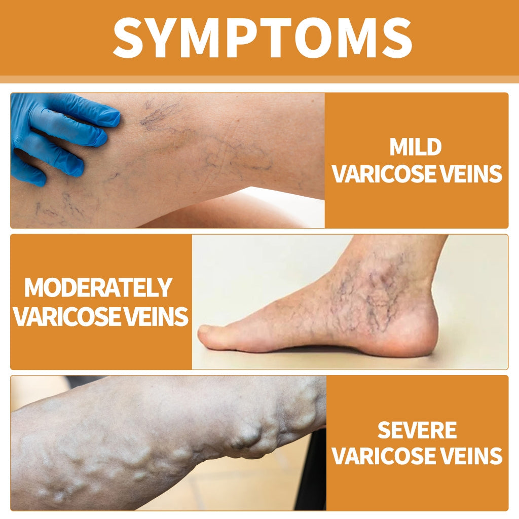 Turmeric Varicose Vein Relief Spray( BUY 1 GET 1 FREE )
